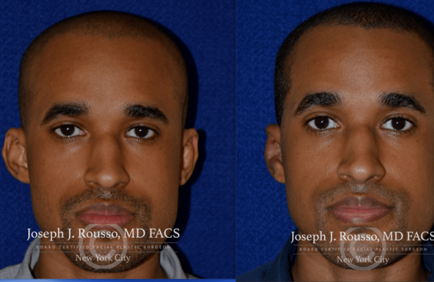 Ears & Microtia before/after photo 5
