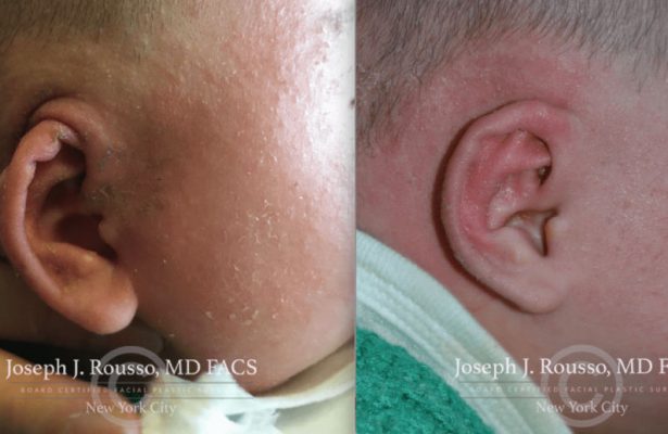 Ears & Microtia before/after photo 11