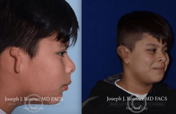 Ears & Microtia before/after photo 2