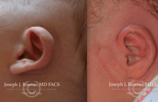 Ears & Microtia before/after photo 7