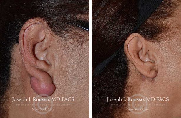Ears & Microtia before/after photo 6