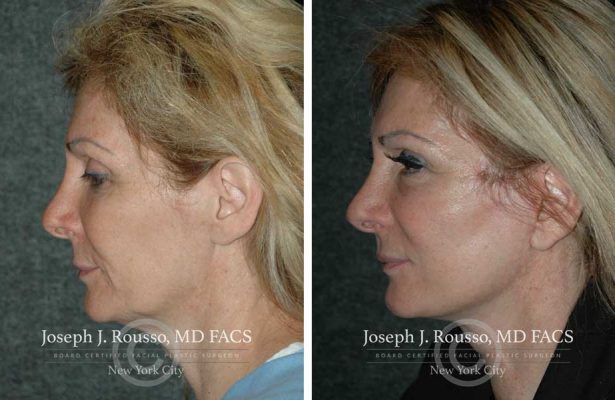 Facelift before/after photo 6