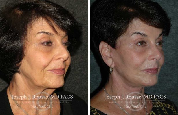 Facelift before/after photo 2