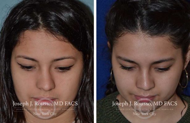 Rhinoplasty before/after photo 1