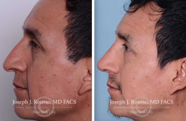 Rhinoplasty before/after photo 10