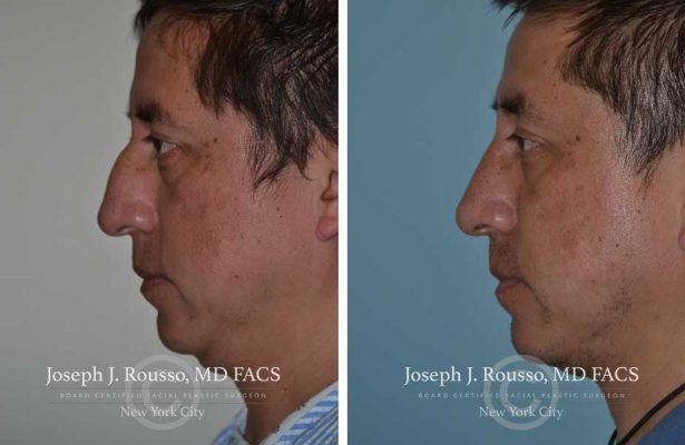 Rhinoplasty before/after photo 2
