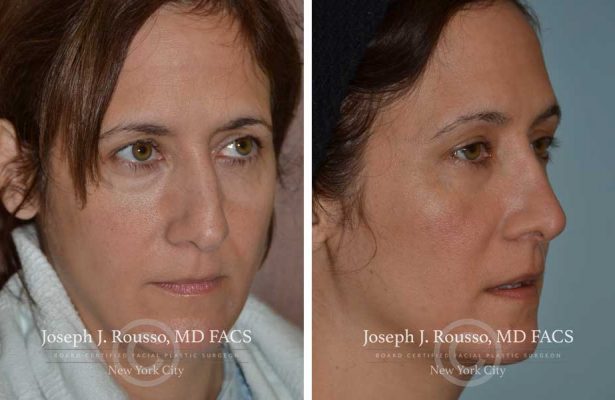 Rhinoplasty before/after photo 3