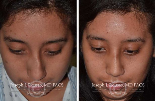 Rhinoplasty before/after photo 12