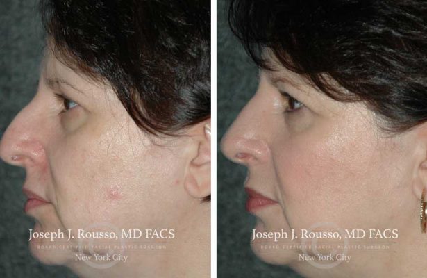 Rhinoplasty before/after photo 4