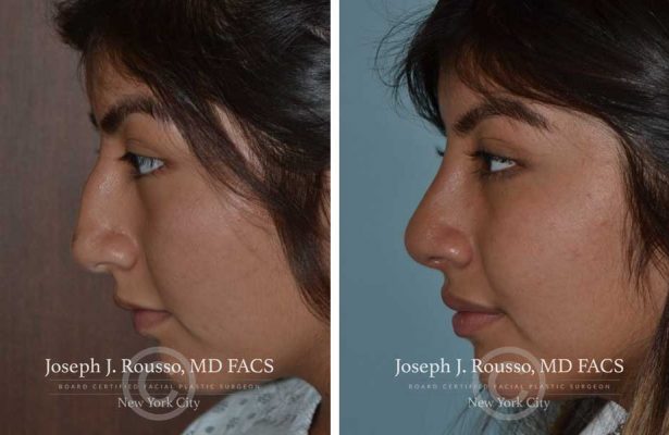Rhinoplasty before/after photo 6