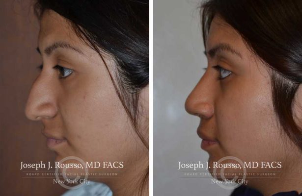 Rhinoplasty before/after photo 7