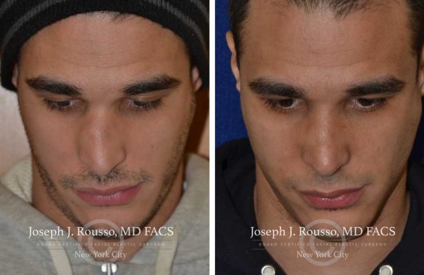 Rhinoplasty before/after photo 11