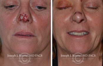 woman Before and After nose Reconstructive Surgery New York, NY