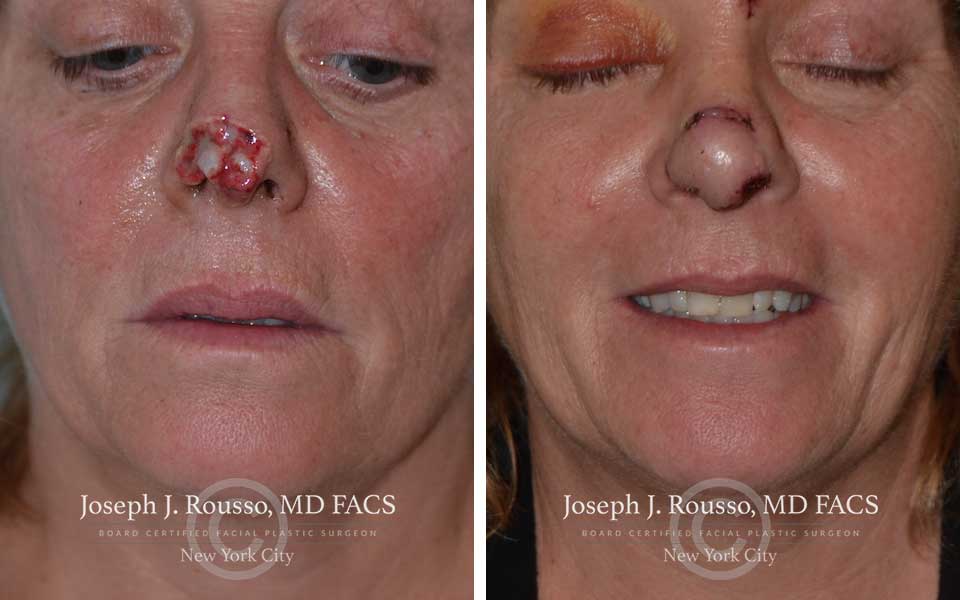 Facial plastic clearance surgery