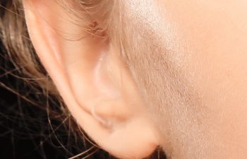 🥇 Torn Earlobe Repair