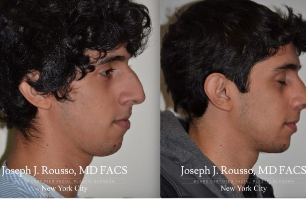 Male Rhinoplasty before/after photo 6