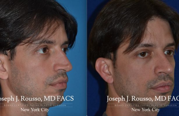 Male Rhinoplasty before/after photo 1