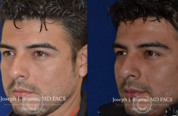 Male Rhinoplasty before/after photo 2