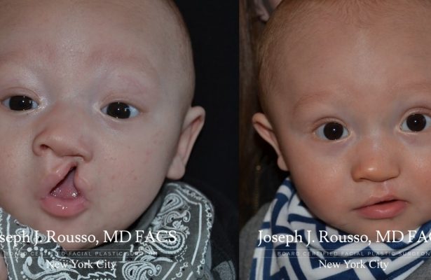 Cleft Lip & Palate before/after photo 1