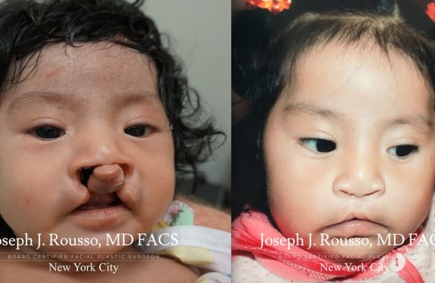 Cleft Lip & Palate before/after photo 1