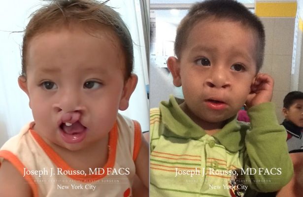 Cleft Lip & Palate before/after photo 2