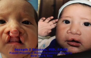 baby before and after cleft lip plastic surgeon new york, ny, 