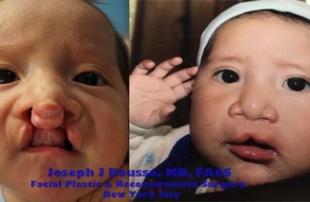 Cleft Lip & Palate before/after photo 3