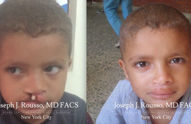 Cleft Lip & Palate before/after photo 4