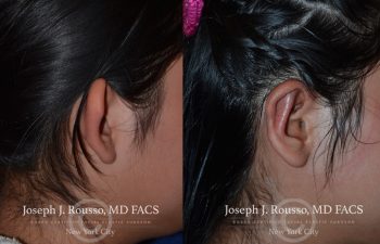 person before and after Ear reconstruction new york, ny