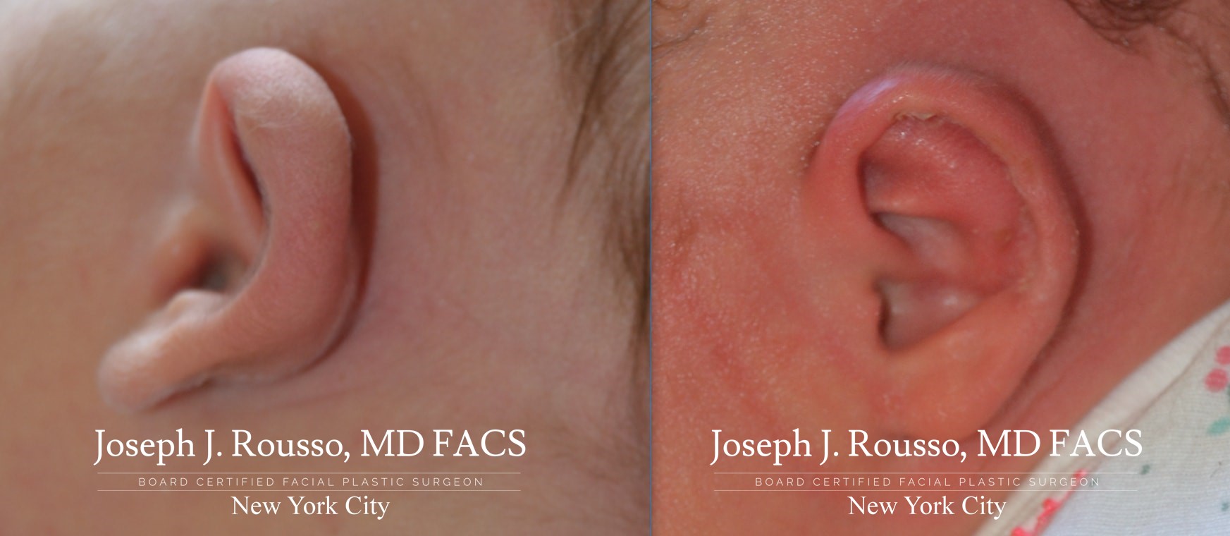 Protruding Ears - Prominent Ears - Earwell™ Infant Ear Correction System
