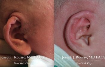 EarWell™ Infant Ear Correction Before/after 6
