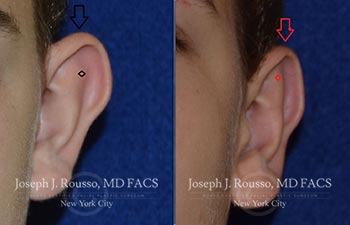 Before and After Images of Ear Deformities