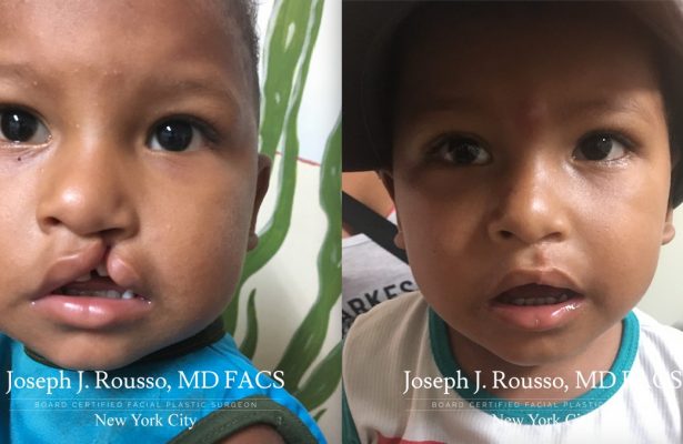 Cleft Lip & Palate before/after photo 6
