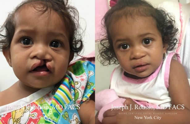 Cleft Lip & Palate before/after photo 7
