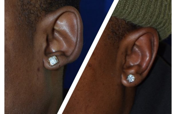 Otoplasty/Ear Pinning before/after photo 8