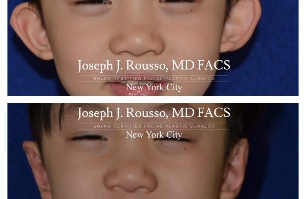 Ears & Microtia before/after photo 9