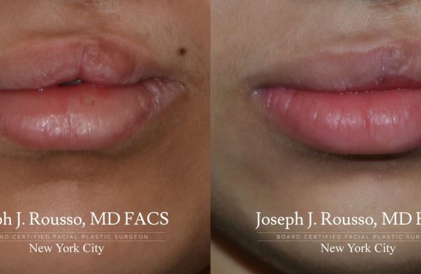 Cleft Lip & Palate before/after photo 8