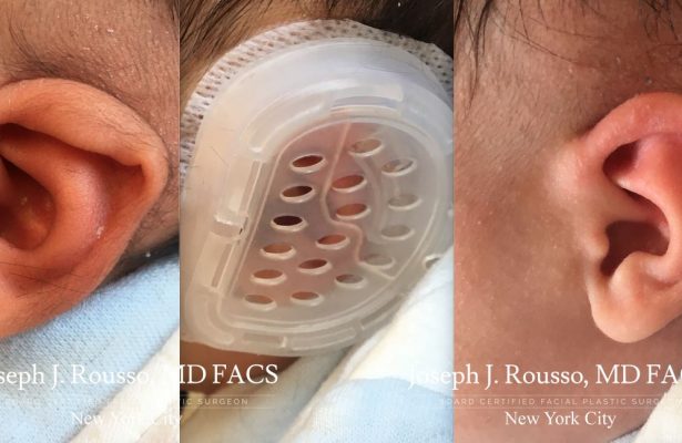 Ears & Microtia before/after photo 1