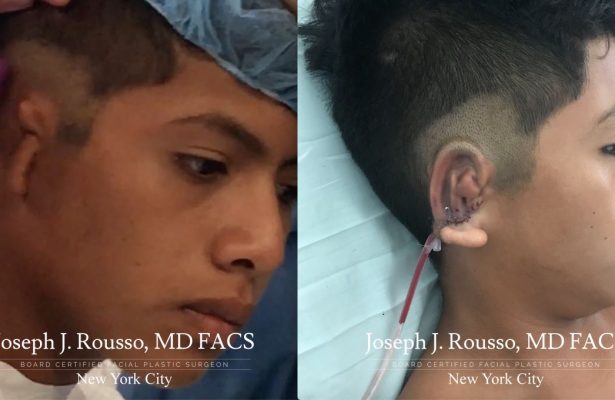 Ears & Microtia before/after photo 2