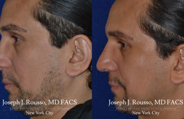 Male Rhinoplasty before/after photo 3