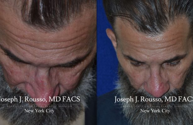 Male Rhinoplasty before/after photo 4