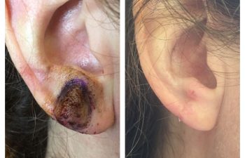 before and after earlobe repair new york, ny
