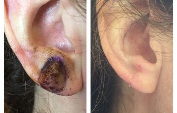 🥇 Earlobe Injury Repair with Plastic Surgery