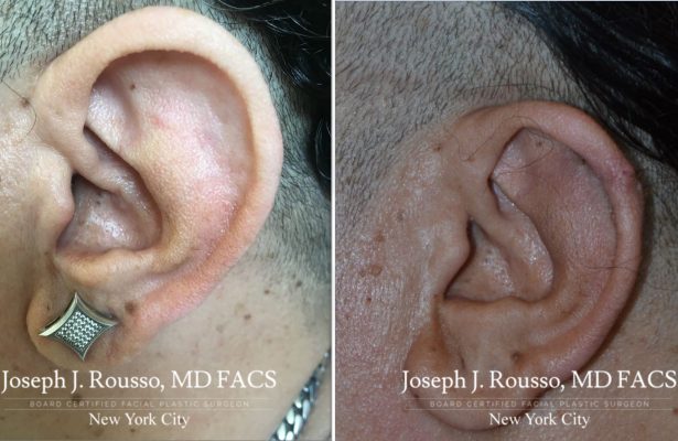 Ears & Microtia before/after photo 1