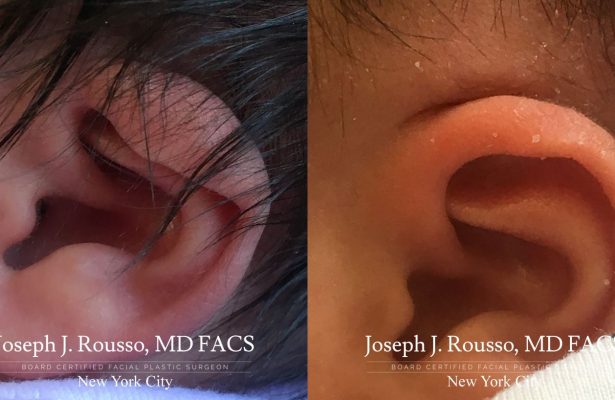 Ears & Microtia before/after photo 4