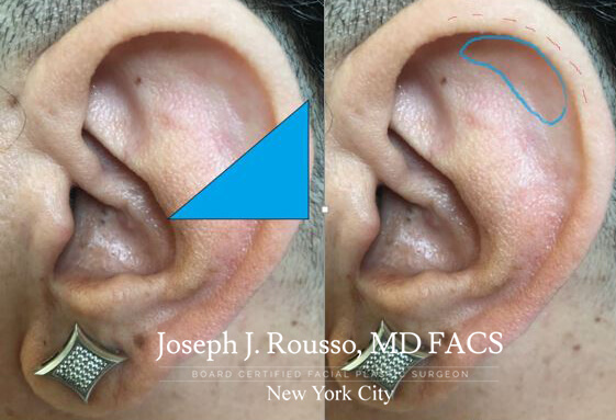 Earlobe Repair NYC, Earlobe Reduction Manhattan