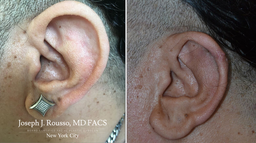 before and after photo of ear reduction