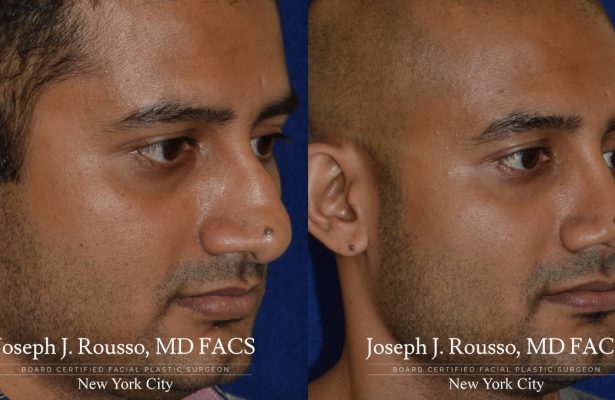 Male Rhinoplasty before/after photo 5