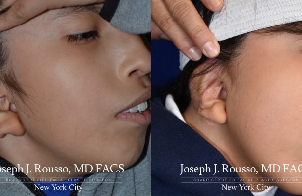Ears & Microtia before/after photo 5