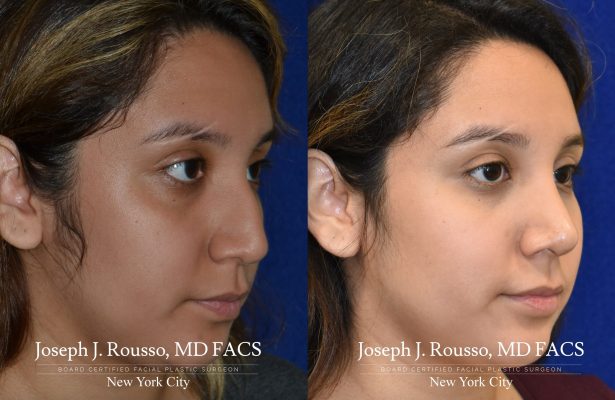 Rhinoplasty before/after photo 10